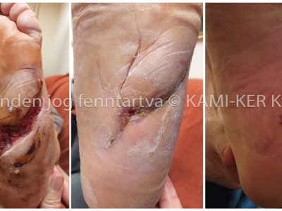 nehezen gyógyuló seb