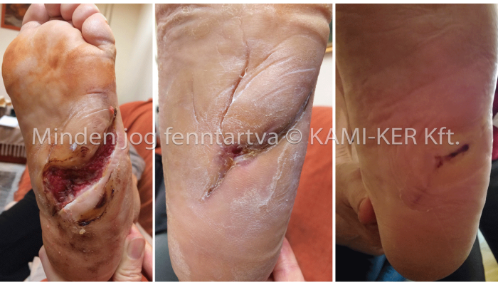 nehezen gyógyuló seb